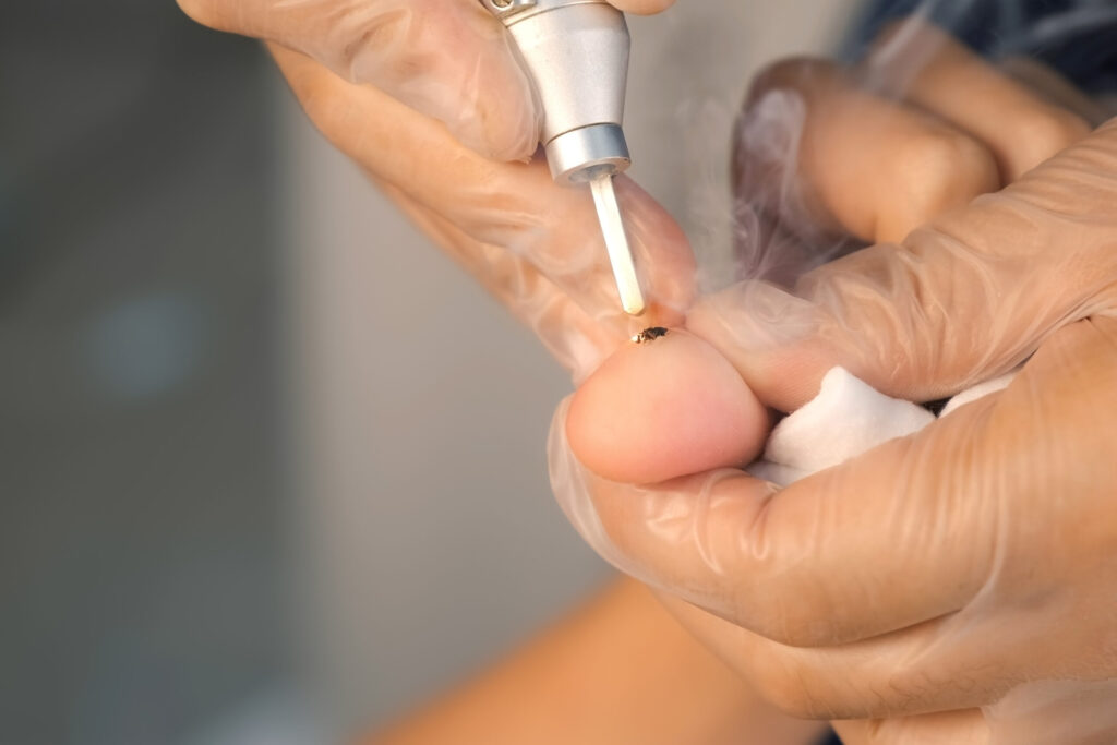 Laserowe leczenie brodawek wirusowych