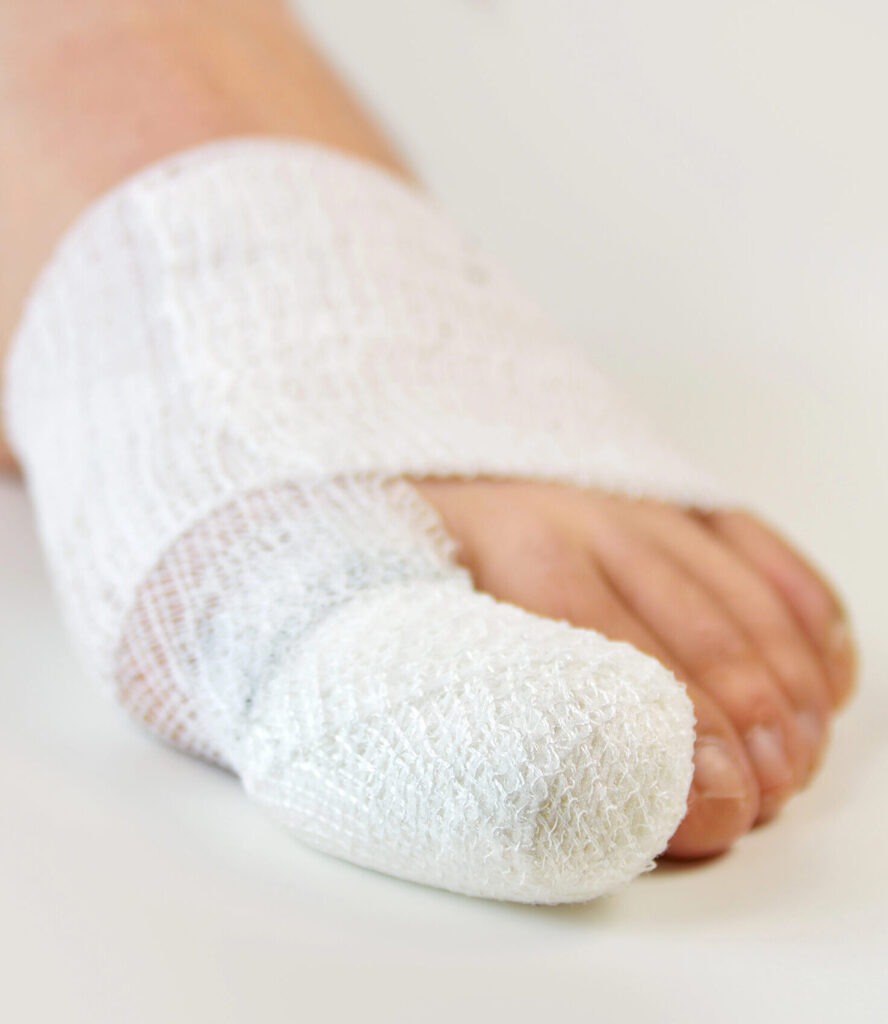 Usunięcie egzostozy