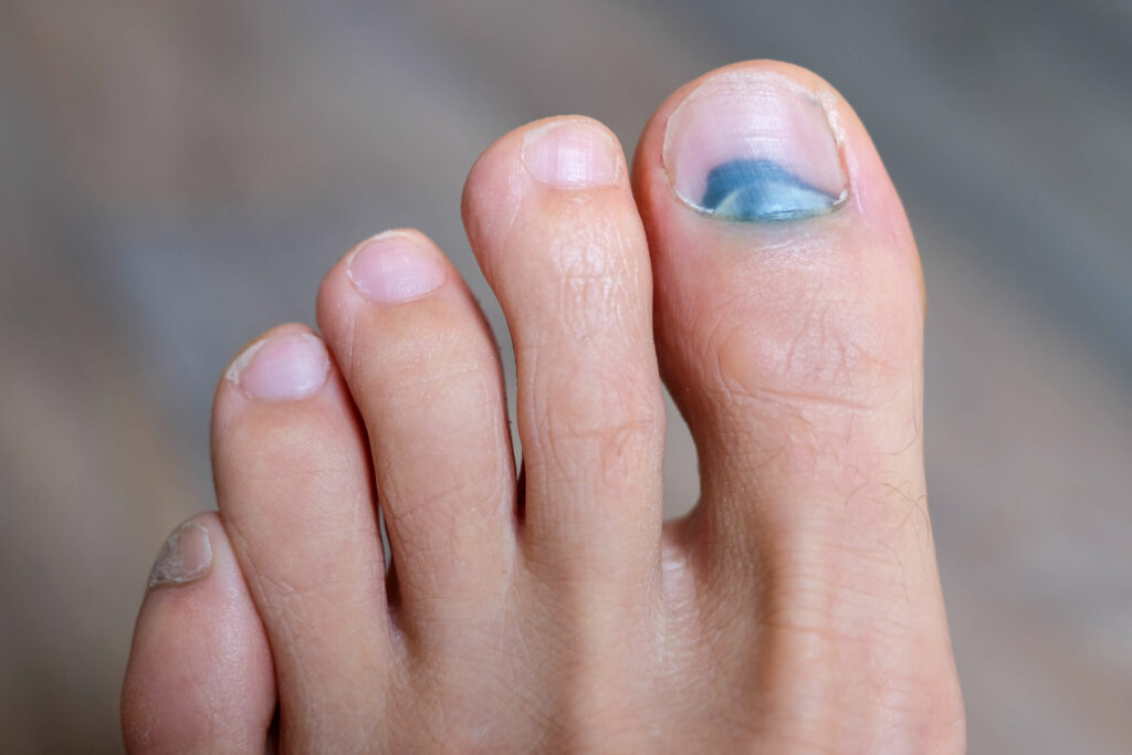 Usunięcie krwiaka podpaznokciowego